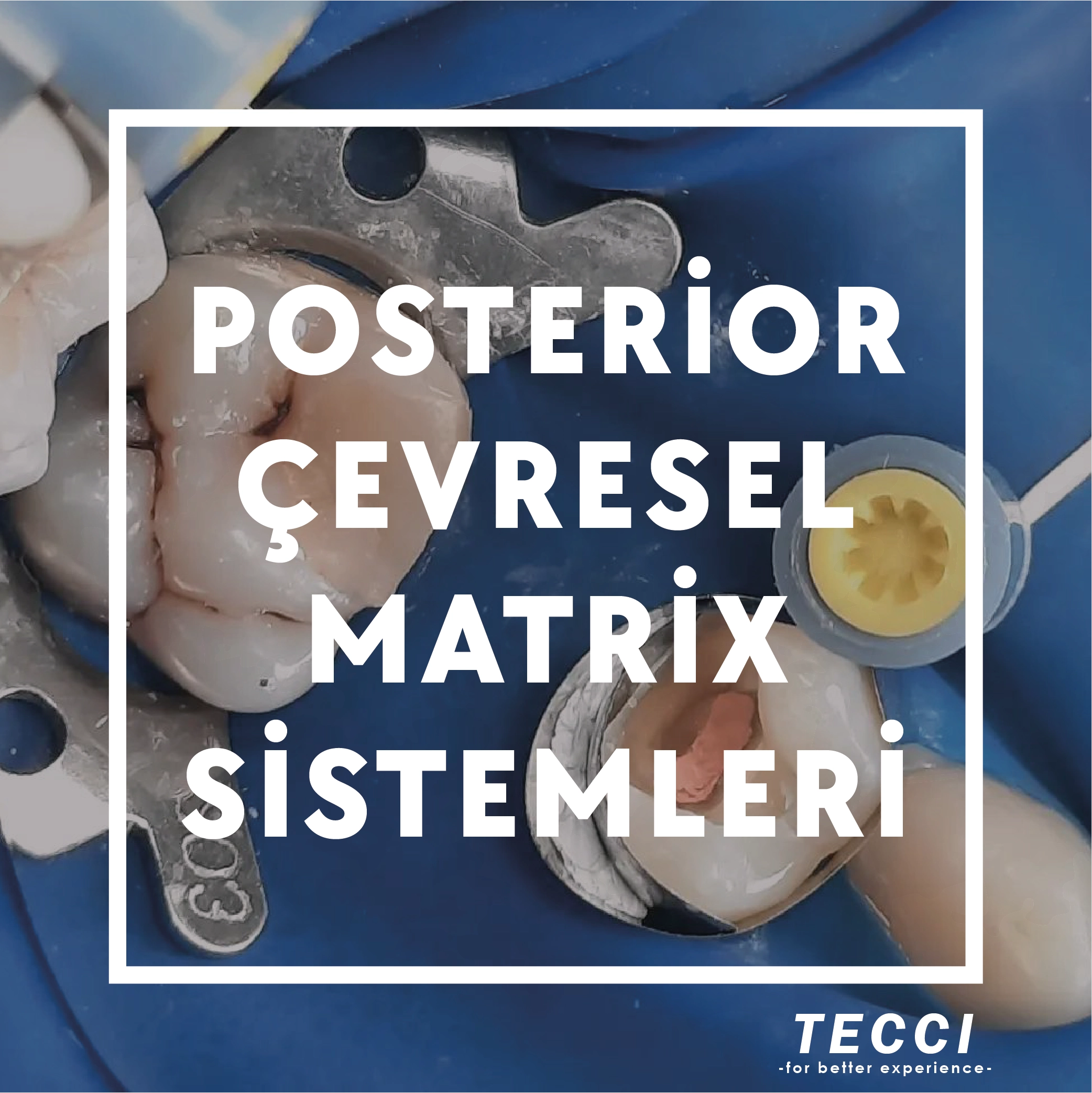 Tecci Posterior Çevresel Matrix Sistemleri